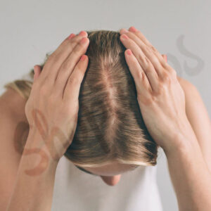 علت ایجاد شوره سر , تفاوت شوره سر و پوسته ریزی , علل و درمان خشکی پوست سر